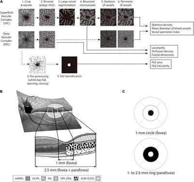 Foveal Remodeling of Retinal Microvasculature in Parkinson’s Disease